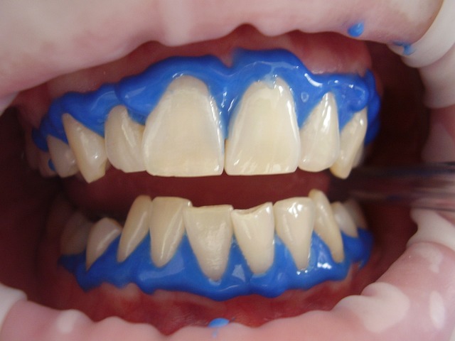 The Ultimate Guide To Laser Teeth Whitening: Achieve A Dazzling Smile