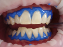 The Ultimate Guide To Laser Teeth Whitening: Achieve A Dazzling Smile