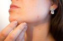 Getting Rid Of Acne Scars—The Ultimate Guide